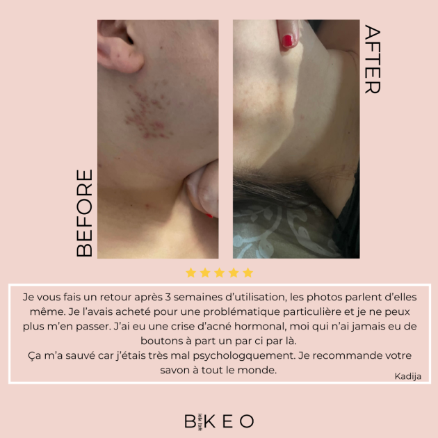 avant après acne hormonal site